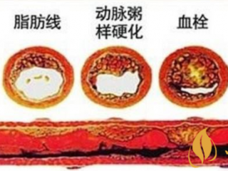 吸烟会导致动脉硬化 破坏全身血管